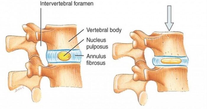 Mkb-10 La escoliosis del departamento de pecho de la columna vertebral de 1 grado