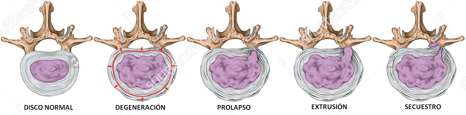 Que es posible a sheynom la osteocondrosis