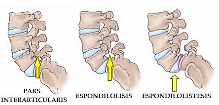 What makes spondylolisthesis worse What makes spondylolisthesis worse picture