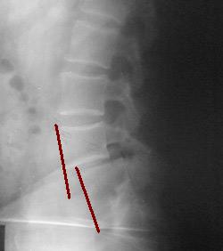 desplazamiento de vertebra cervical tratamiento