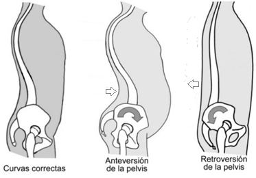 dolor de cuello de la inclinación pélvica anterior