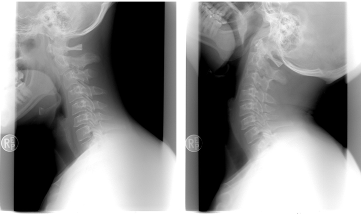 ejercicios para rectificacion cervical