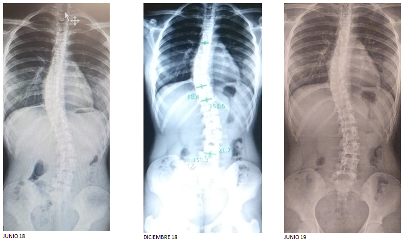 escoliosis en adolescentes