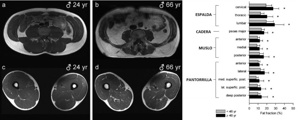 Pérdida de musculatura lumbar profunda con la edad